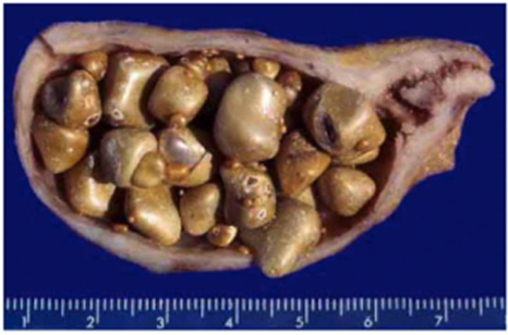 colecistitis